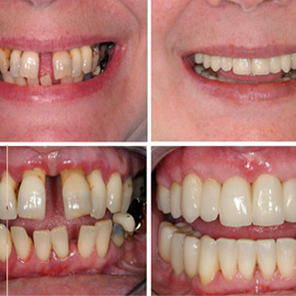 Dental Gum Treatments Kuwait