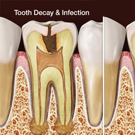 Root canal Treatments Kuwait