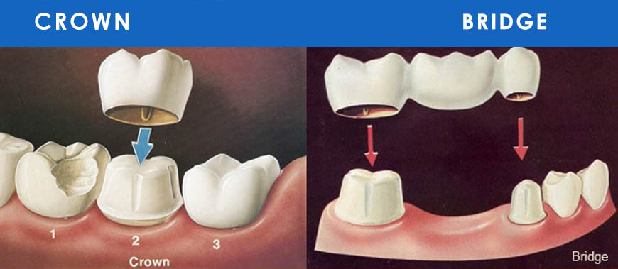 dental implants treatments in Kuwait