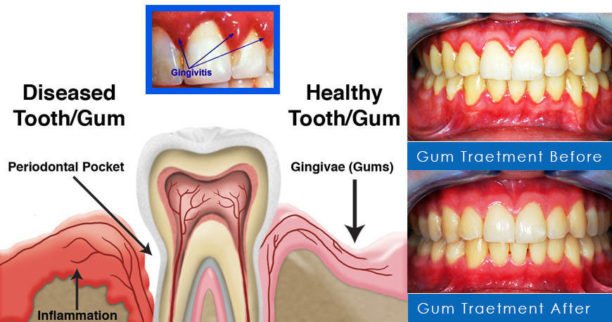 dental gum treatments in Kuwait