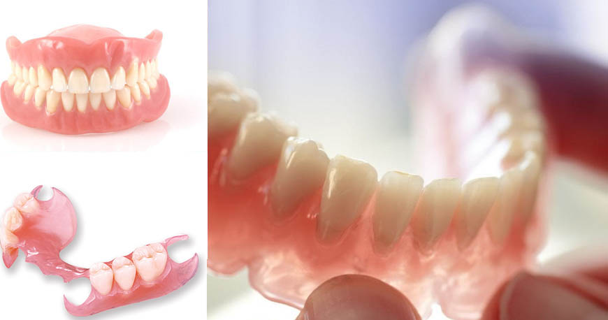dental implants treatments in Kuwait