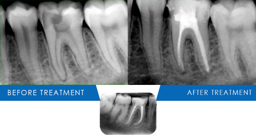 root canal treatments in Kuwait